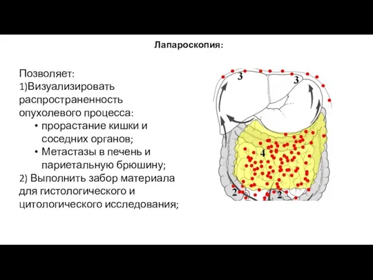 Лапароскопия: Позволяет: 1)Визуализировать распространенность опухолевого процесса: прорастание кишки и соседних органов; Метастазы