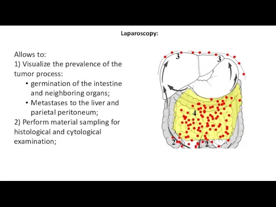 Laparoscopy: Allows to: 1) Visualize the prevalence of the tumor process: germination