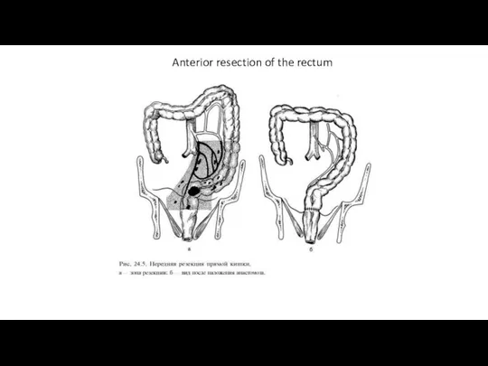 Anterior resection of the rectum
