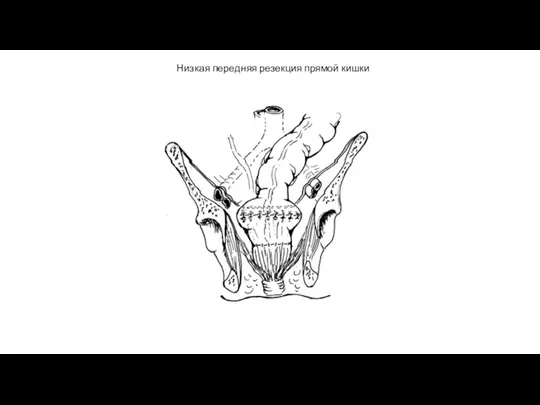 Низкая передняя резекция прямой кишки