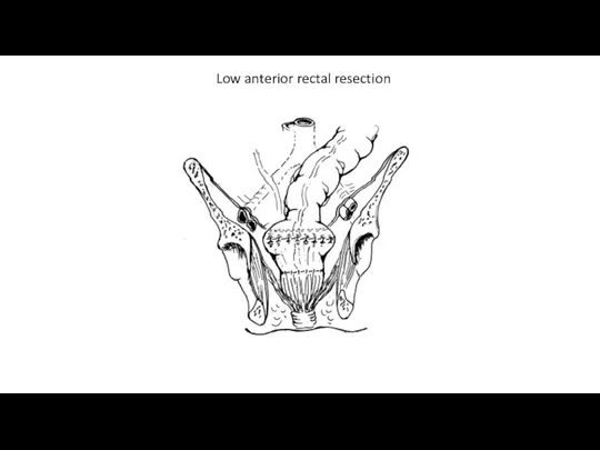 Low anterior rectal resection