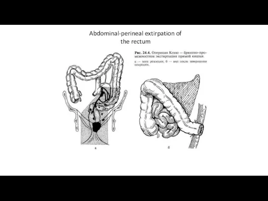 Abdominal-perineal extirpation of the rectum