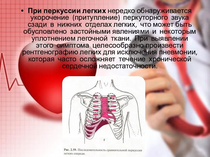 При перкуссии легких нередко обнаруживается укорочение (притупление) перкуторного звука сзади в нижних