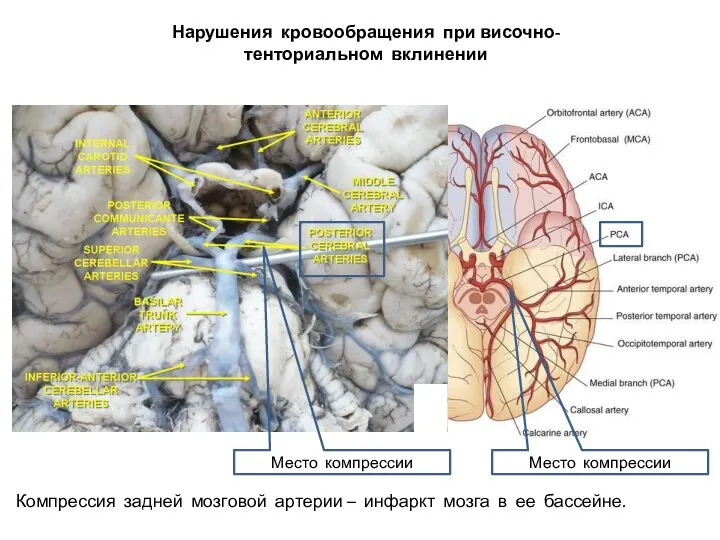 Нарушения кровообращения при височно-тенториальном вклинении Компрессия задней мозговой артерии – инфаркт мозга