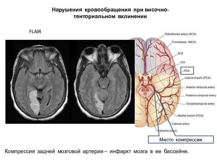 Нарушения кровообращения при височно-тенториальном вклинении Компрессия задней мозговой артерии – инфаркт мозга