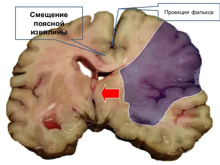 Смещение поясной извилины Проекция фалькса