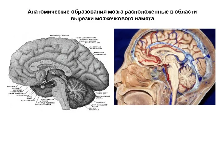 Анатомические образования мозга расположенные в области вырезки мозжечкового намета