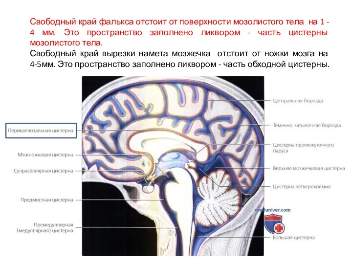 Свободный край фалькса отстоит от поверхности мозолистого тела на 1 - 4