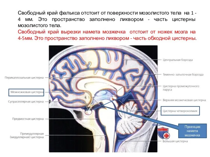 Свободный край фалькса отстоит от поверхности мозолистого тела на 1 - 4