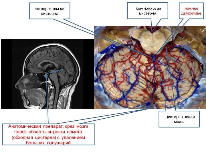 цистерна ножки мозга межножковая цистерна четверохолмная цистерна нижнее двухолмье Анатомический препарат, срез