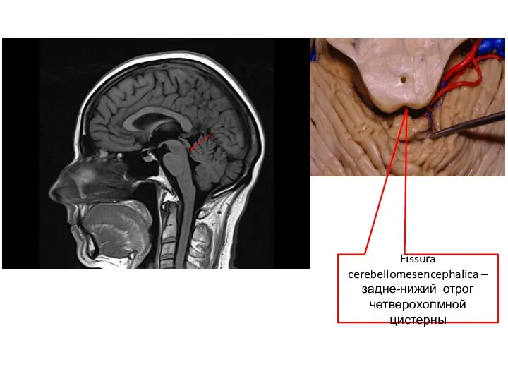 Fissura cerebellomesencephalica – задне-нижий отрог четверохолмной цистерны