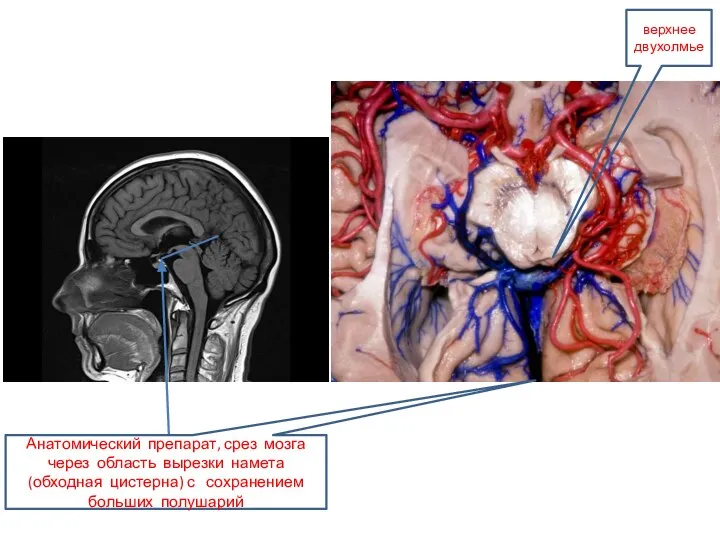 верхнее двухолмье Анатомический препарат, срез мозга через область вырезки намета (обходная цистерна) с сохранением больших полушарий