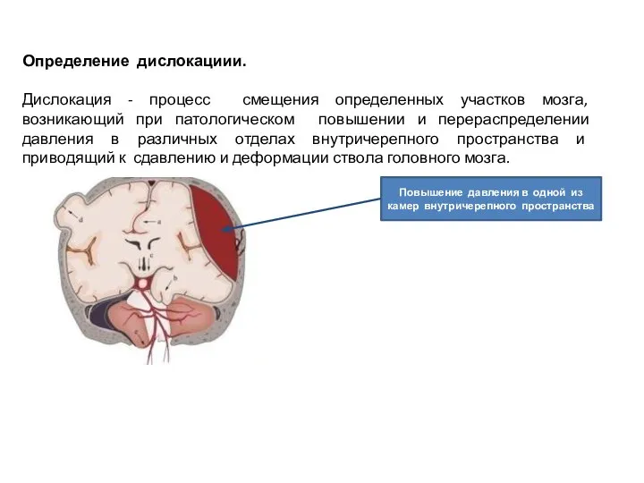 Определение дислокациии. Дислокация - процесс смещения определенных участков мозга, возникающий при патологическом