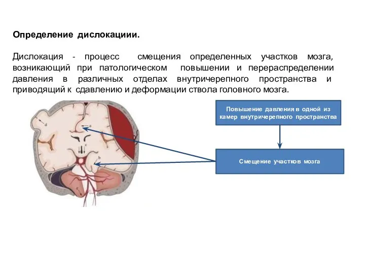 Определение дислокациии. Дислокация - процесс смещения определенных участков мозга, возникающий при патологическом