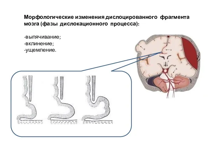 Морфологические изменения дислоцированного фрагмента мозга (фазы дислокационного процесса): -выпячивание; -вклинение; -ущемление.