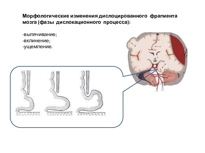 Морфологические изменения дислоцированного фрагмента мозга (фазы дислокационного процесса): -выпячивание; -вклинение; -ущемление.