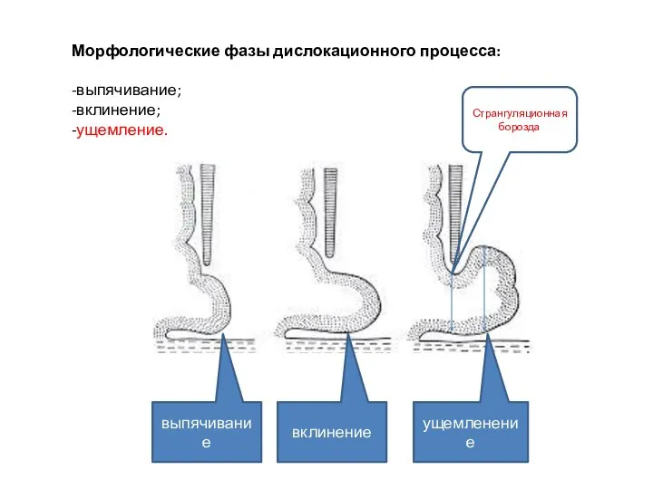 Морфологические фазы дислокационного процесса: -выпячивание; -вклинение; -ущемление. выпячивание вклинение ущемленение Странгуляционная борозда