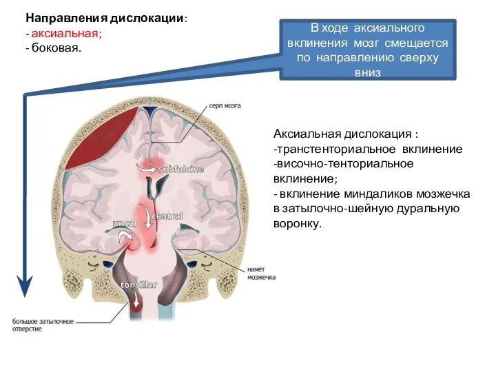 Направления дислокации: - аксиальная; - боковая. Аксиальная дислокация : -транстенториальное вклинение -височно-тенториальное