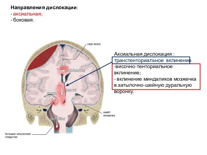 Направления дислокации: - аксиальная; - боковая. Аксиальная дислокация : транстенториальное вклинение -височно-тенториальное