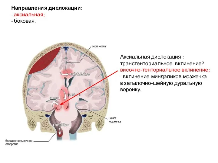 Направления дислокации: - аксиальная; - боковая. Аксиальная дислокация : транстенториальное вклинение? височно-тенториальное