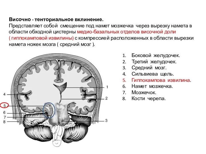 Височно - тенториальное вклинение. Представляет собой смещение под намет мозжечка через вырезку