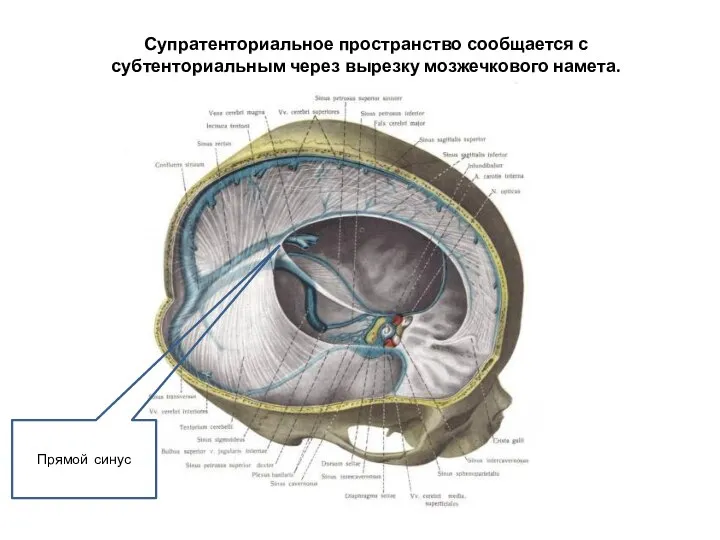 Супратенториальное пространство сообщается с субтенториальным через вырезку мозжечкового намета. Прямой синус