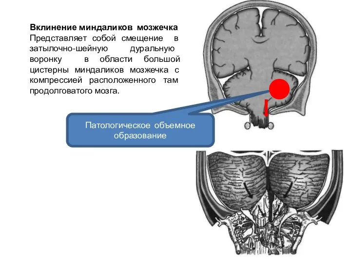 Вклинение миндаликов мозжечка Представляет собой смещение в затылочно-шейную дуральную воронку в области