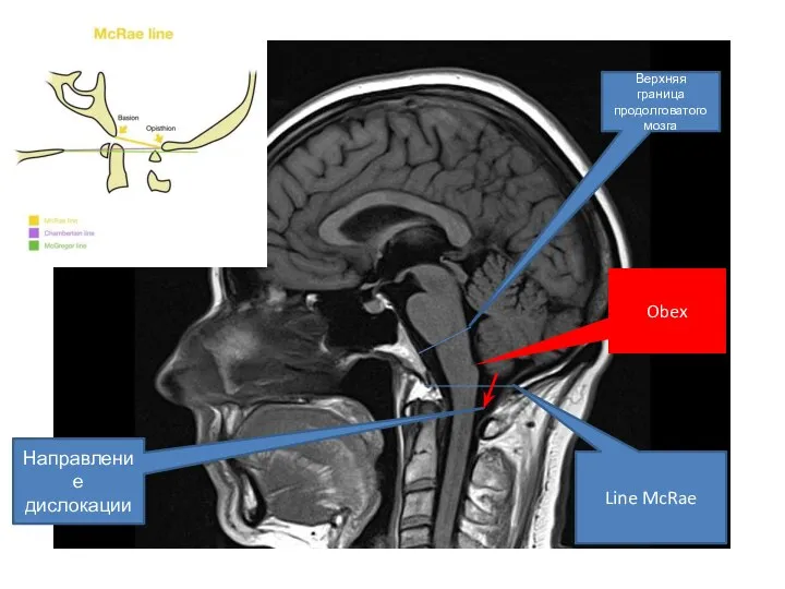 Верхняя граница продолговатого мозга Line McRae Obex Направление дислокации