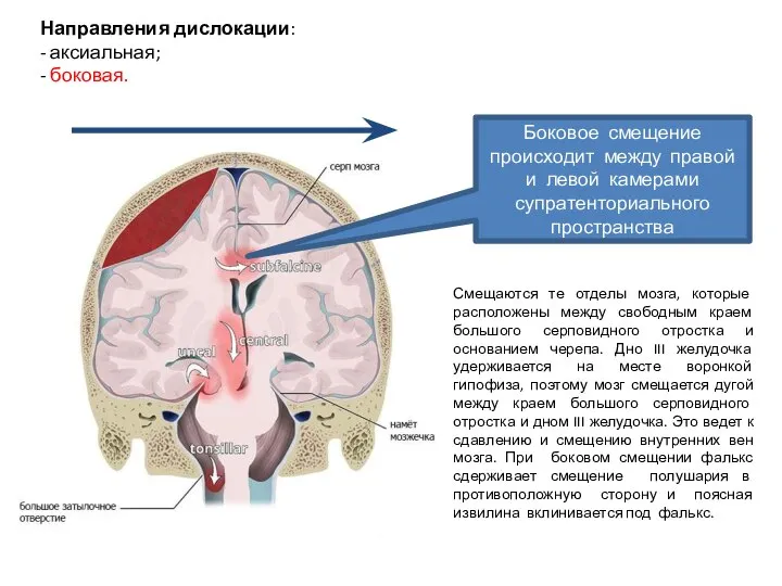 Направления дислокации: - аксиальная; - боковая. Боковое смещение происходит между правой и