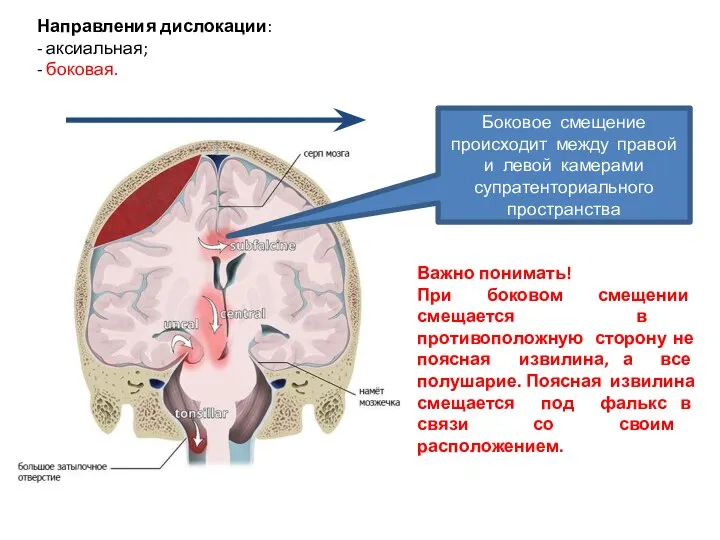 Направления дислокации: - аксиальная; - боковая. Боковое смещение происходит между правой и