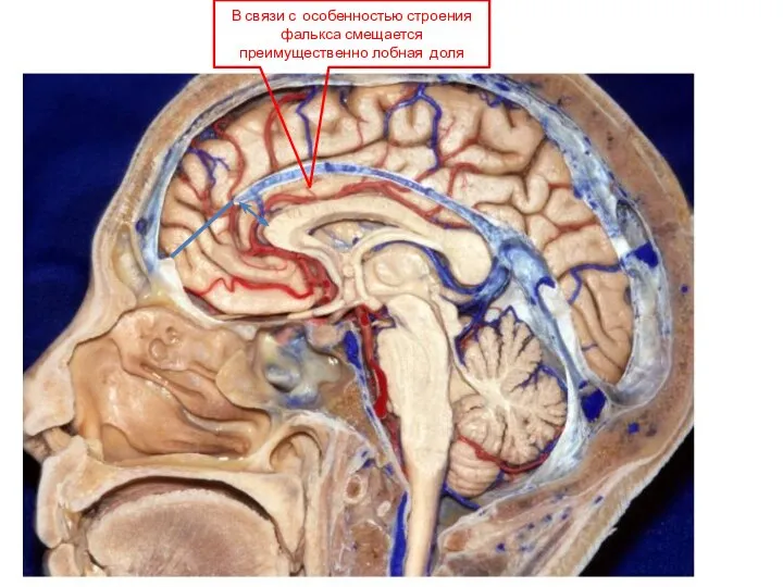 В связи с особенностью строения фалькса смещается преимущественно лобная доля