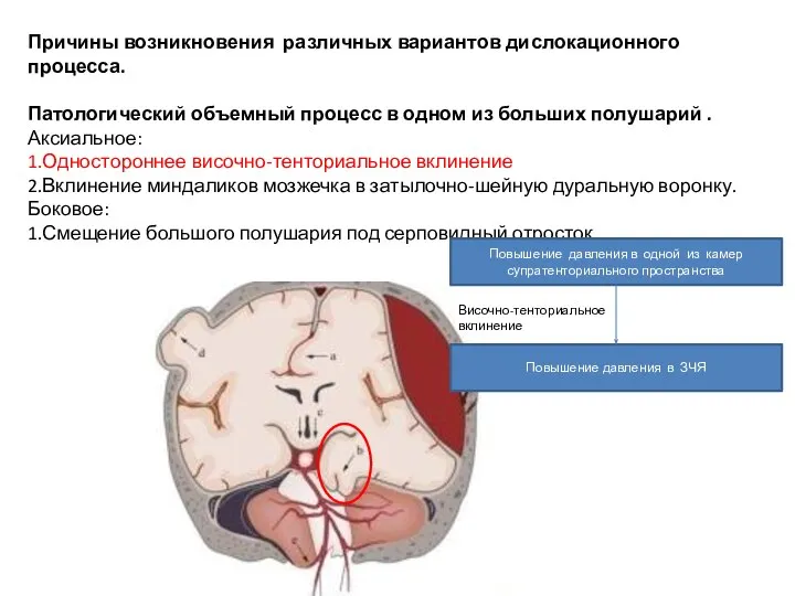 Причины возникновения различных вариантов дислокационного процесса. Патологический объемный процесс в одном из