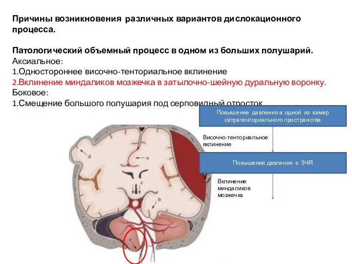 Причины возникновения различных вариантов дислокационного процесса. Патологический объемный процесс в одном из