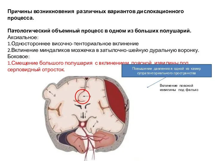 Причины возникновения различных вариантов дислокационного процесса. Патологический объемный процесс в одном из