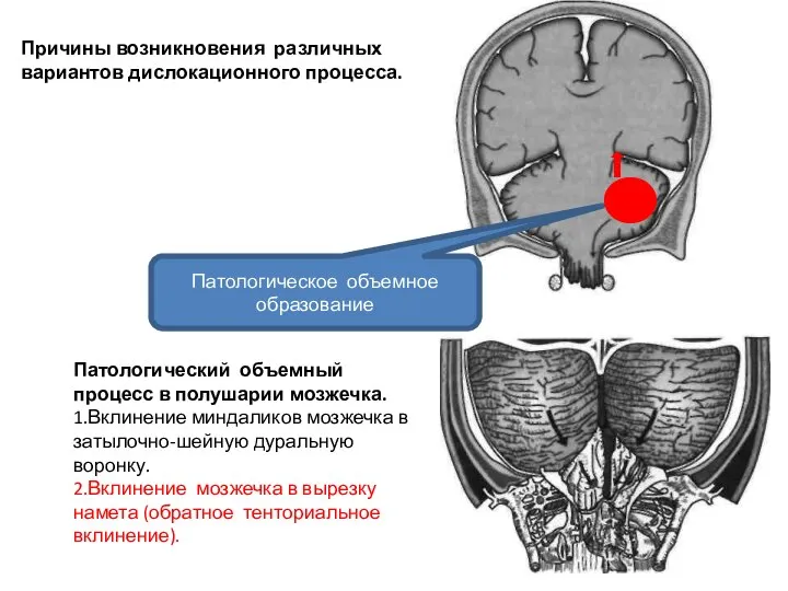 Патологический объемный процесс в полушарии мозжечка. 1.Вклинение миндаликов мозжечка в затылочно-шейную дуральную