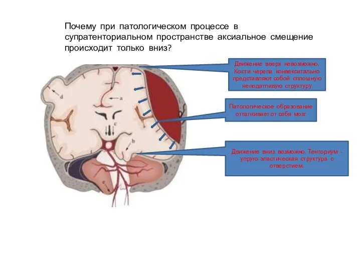 Почему при патологическом процессе в супратенториальном пространстве аксиальное смещение происходит только вниз?