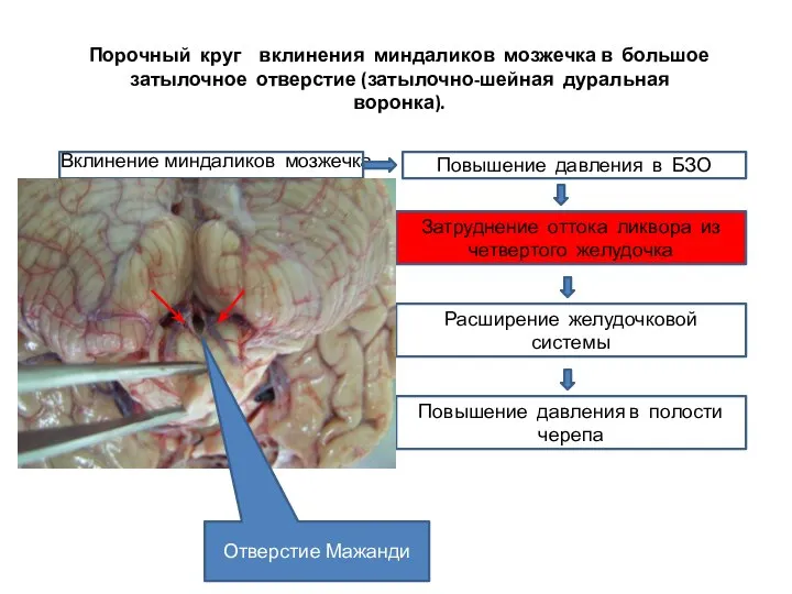 Порочный круг вклинения миндаликов мозжечка в большое затылочное отверстие (затылочно-шейная дуральная воронка).