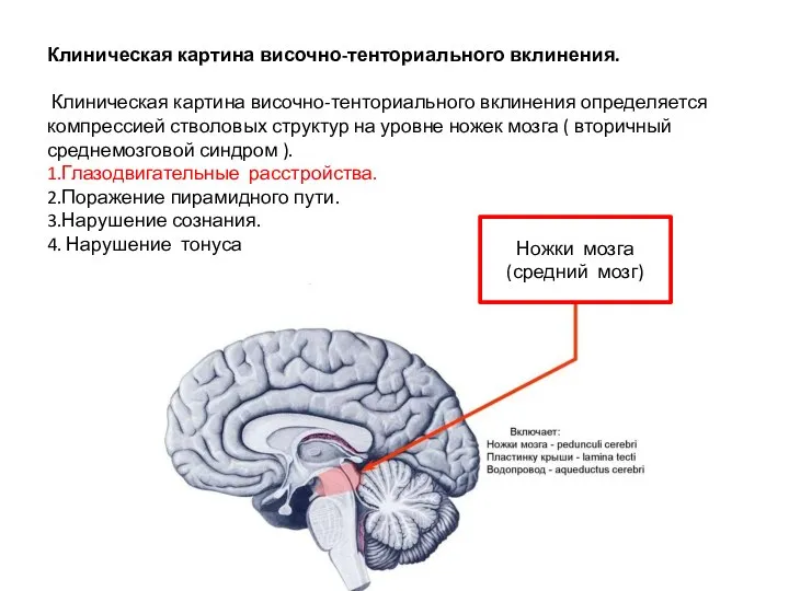 Клиническая картина височно-тенториального вклинения. Клиническая картина височно-тенториального вклинения определяется компрессией стволовых структур