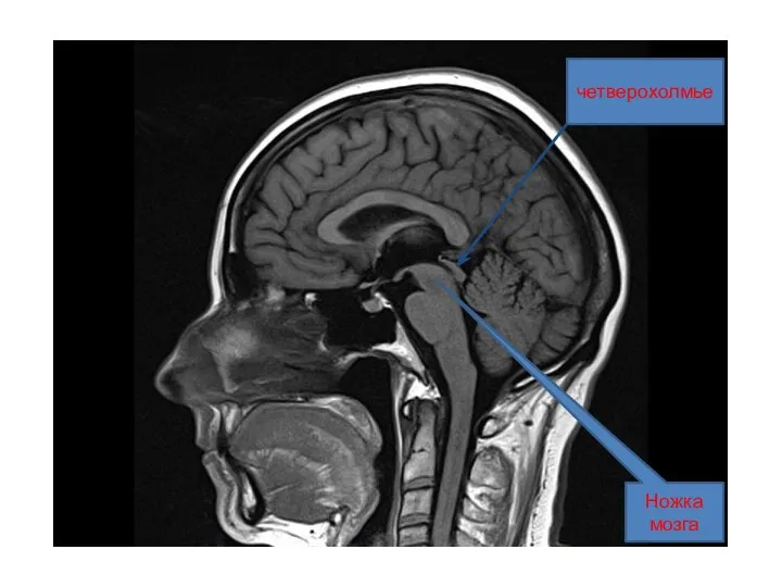 Ножка мозга четверохолмье