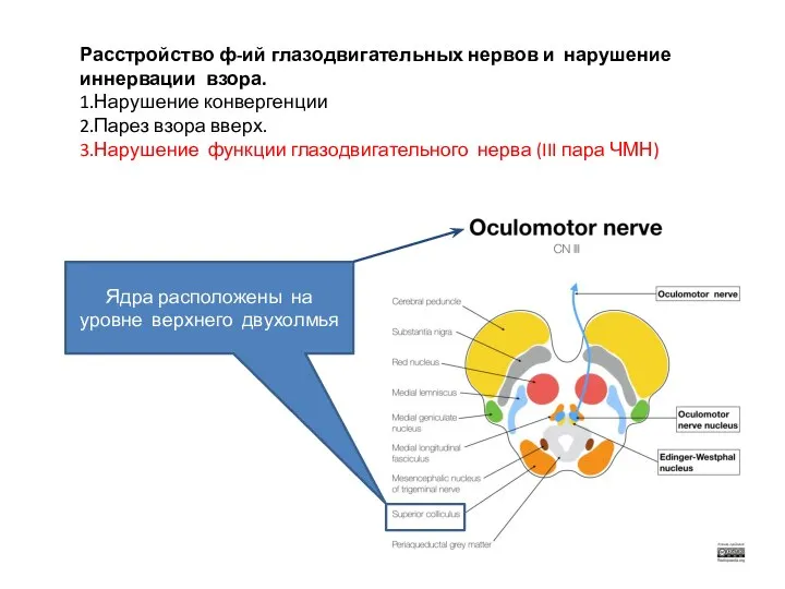 Расстройство ф-ий глазодвигательных нервов и нарушение иннервации взора. 1.Нарушение конвергенции 2.Парез взора