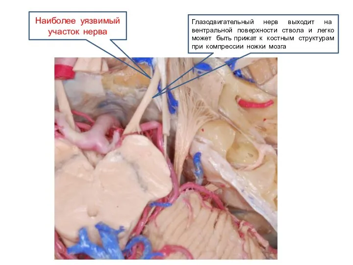 Глазодвигательный нерв выходит на вентральной поверхности ствола и легко может быть прижат