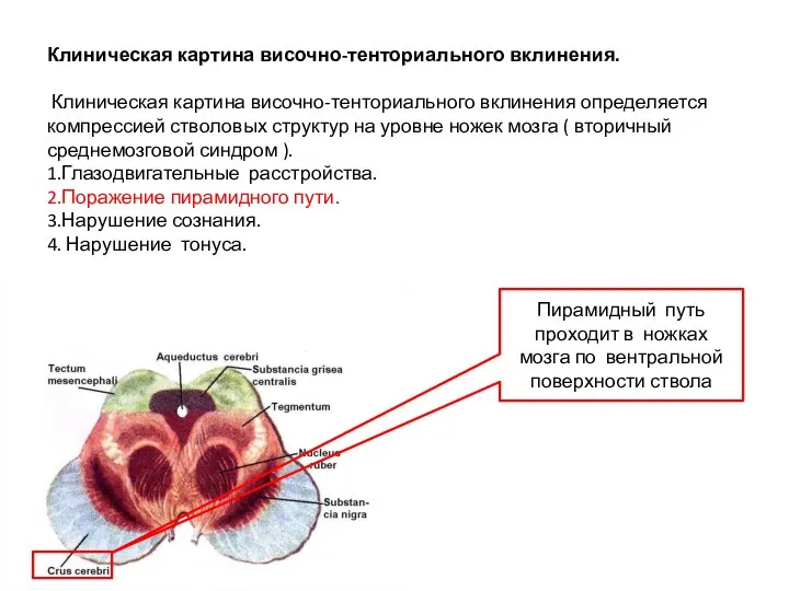 Клиническая картина височно-тенториального вклинения. Клиническая картина височно-тенториального вклинения определяется компрессией стволовых структур