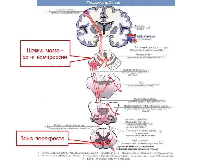 Ножка мозга – зона компрессии Зона перекреста