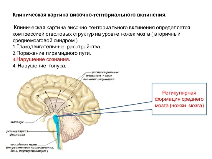 Клиническая картина височно-тенториального вклинения. Клиническая картина височно-тенториального вклинения определяется компрессией стволовых структур