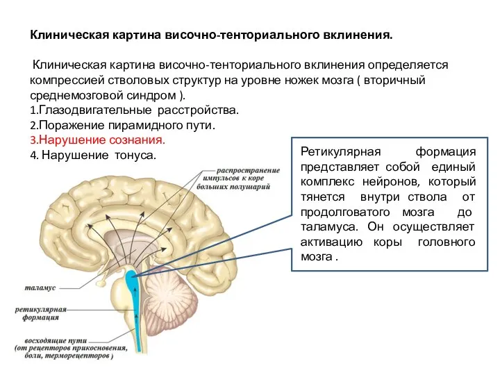 Клиническая картина височно-тенториального вклинения. Клиническая картина височно-тенториального вклинения определяется компрессией стволовых структур