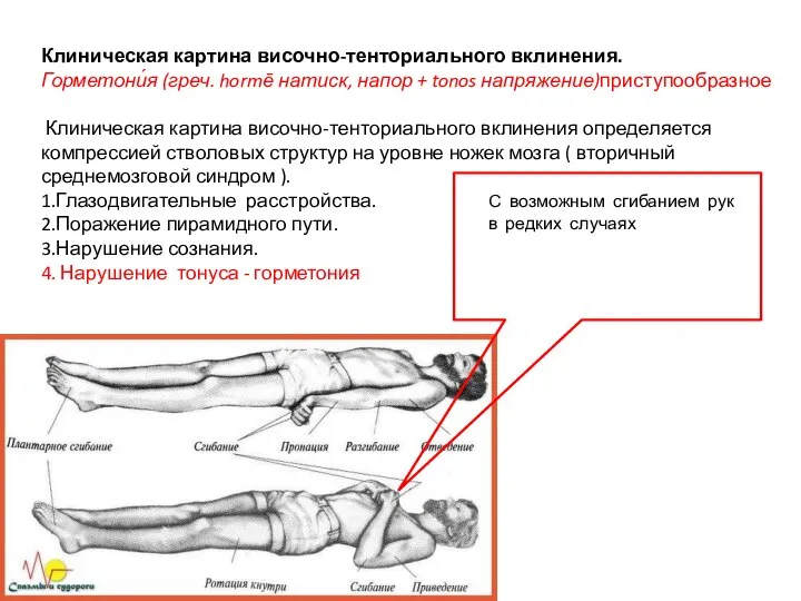 Клиническая картина височно-тенториального вклинения. Горметони́я (греч. hormē натиск, напор + tonos напряжение)приступообразное