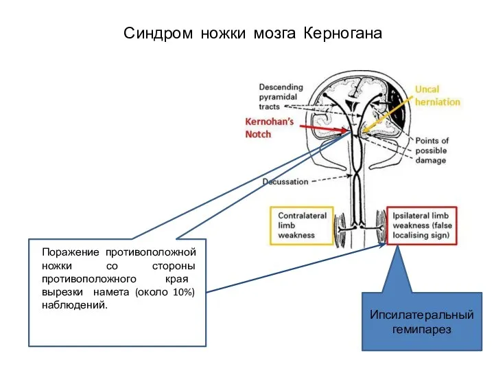 Синдром ножки мозга Керногана Поражение противоположной ножки со стороны противоположного края вырезки