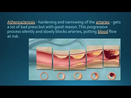 Atherosclerosis - hardening and narrowing of the arteries - gets a lot
