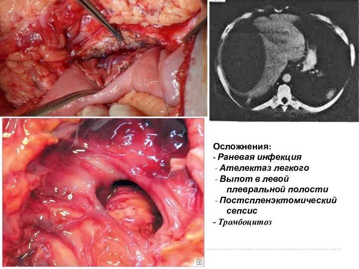 Осложнения: - Раневая инфекция - Ателектаз легкого - Выпот в левой плевральной