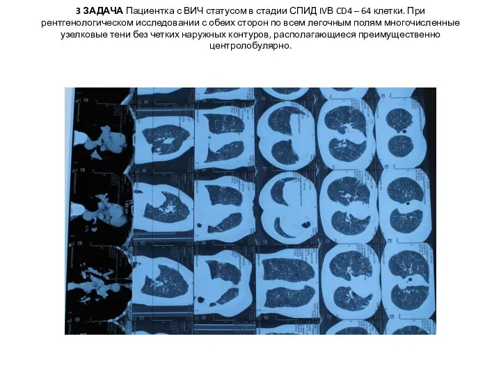 3 ЗАДАЧА Пациентка с ВИЧ статусом в стадии СПИД IVВ CD4 –